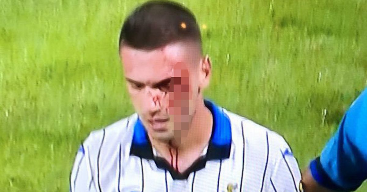 Atalanta’s Merih Demiral suffers vile cut to face as blood pours down shirt