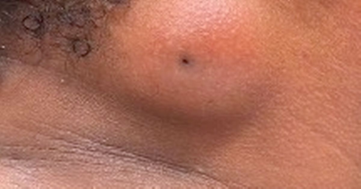 Dr Pimple Popper teases fans with giant cyst and asks them to guess what is inside