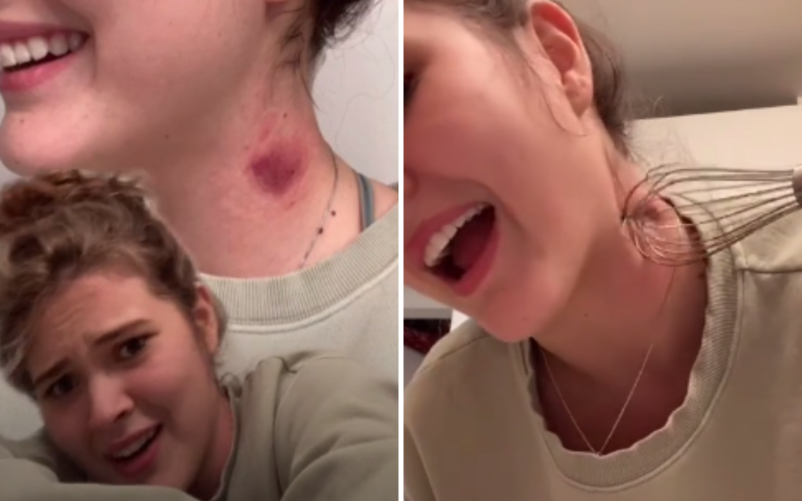 TikTok teens swear by kitchen whisks for getting rid of hickeys. But is it really effective?