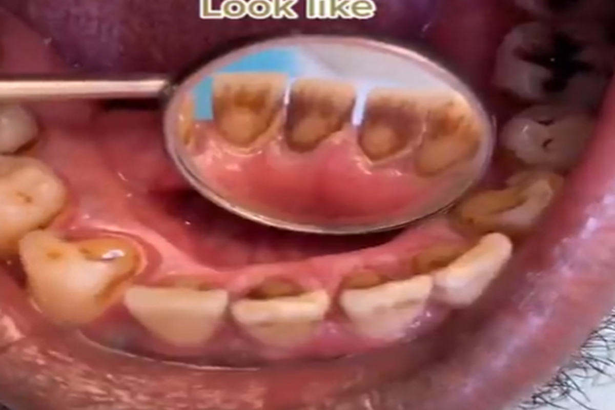 Doctor warns of the damage smoking can do to teeth in shocking TikTok video