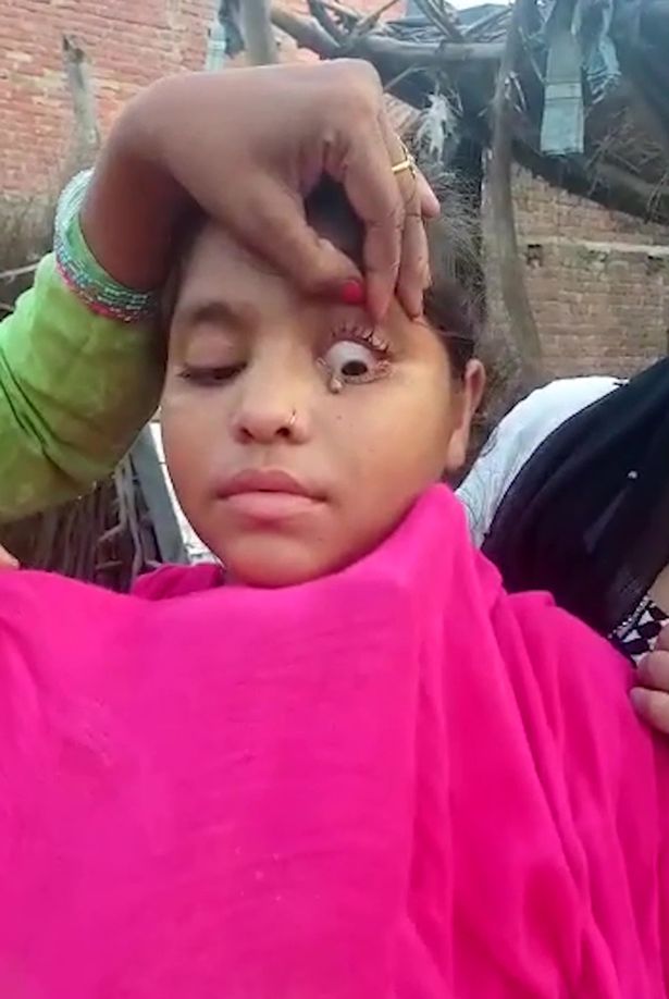 In a clip, which was filmed in the village of Gadiya Balidaspur, a lump can be seen in the upper left-hand side of her eyelid