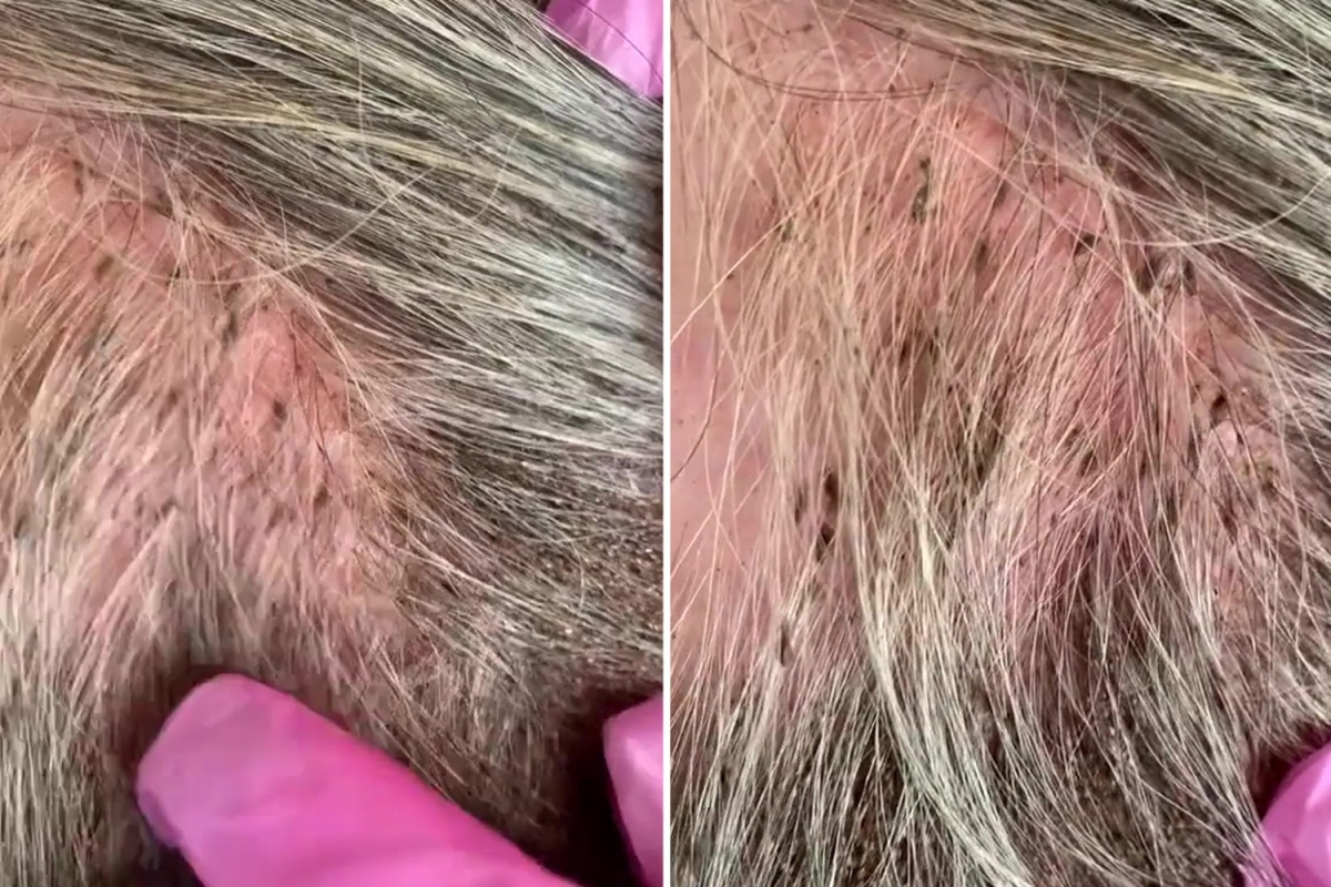 Head lice experts show ‘worst case ever’ as hundreds of bugs cover woman’s head & it’ll leave you feeling very itchy