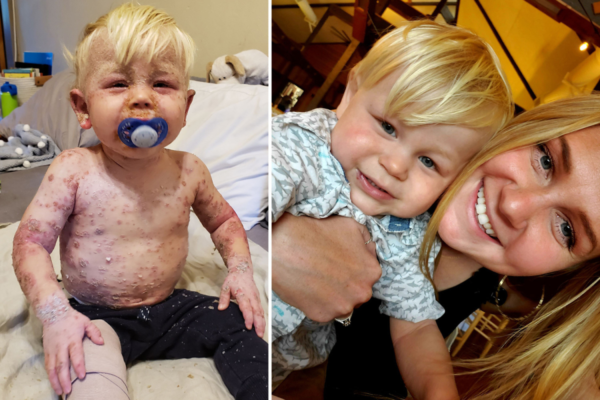 My baby boy’s eczema was so bad people thought he had LEPROSY