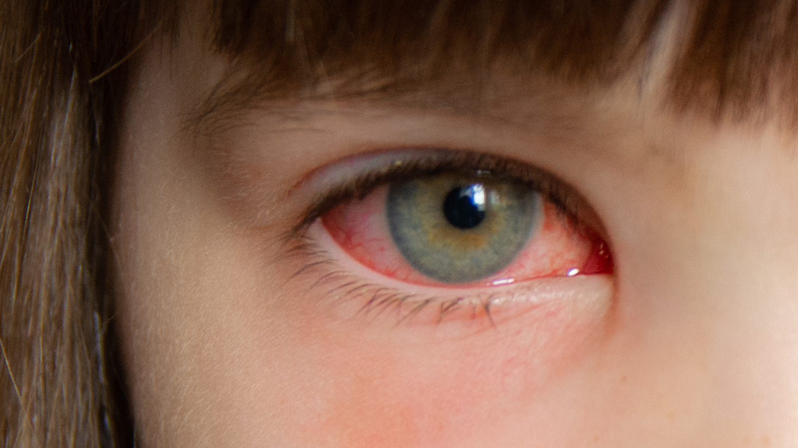 This Is What Really Causes Pink Eye