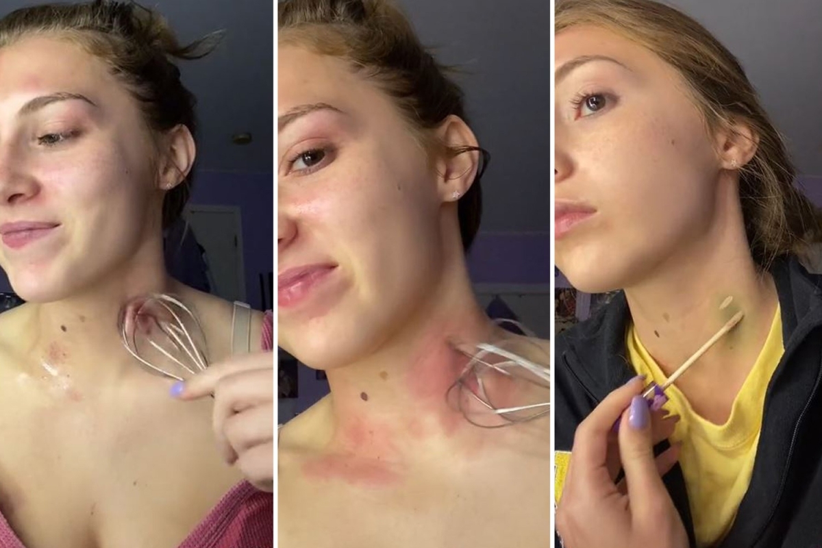 Woman reveals how you can get rid of a love bite using a WHISK and people have been left baffled