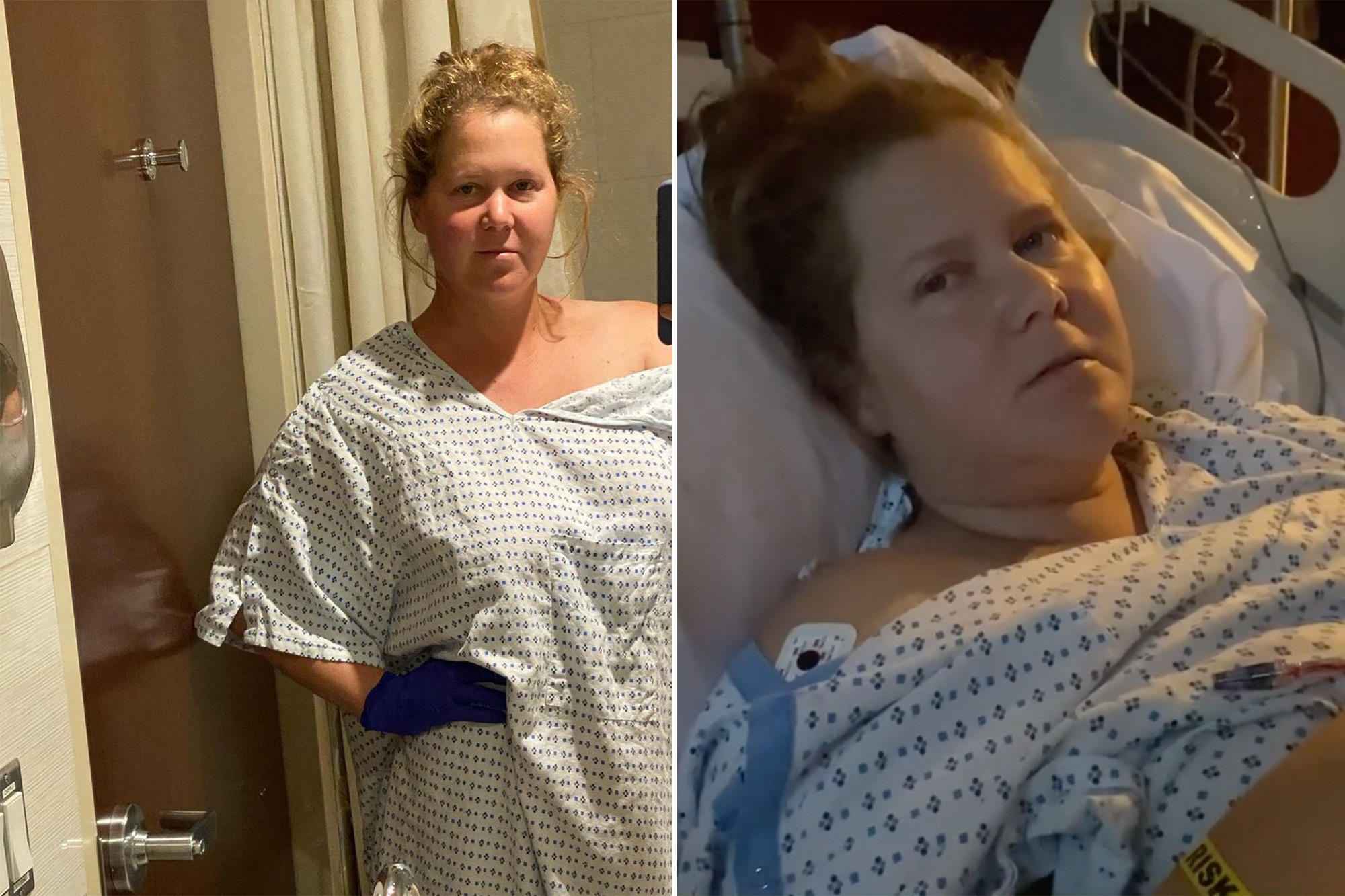 Comedian Amy Schumer Endometriosis Surgery Reveals Her Uterus and Appendix Were Removed!