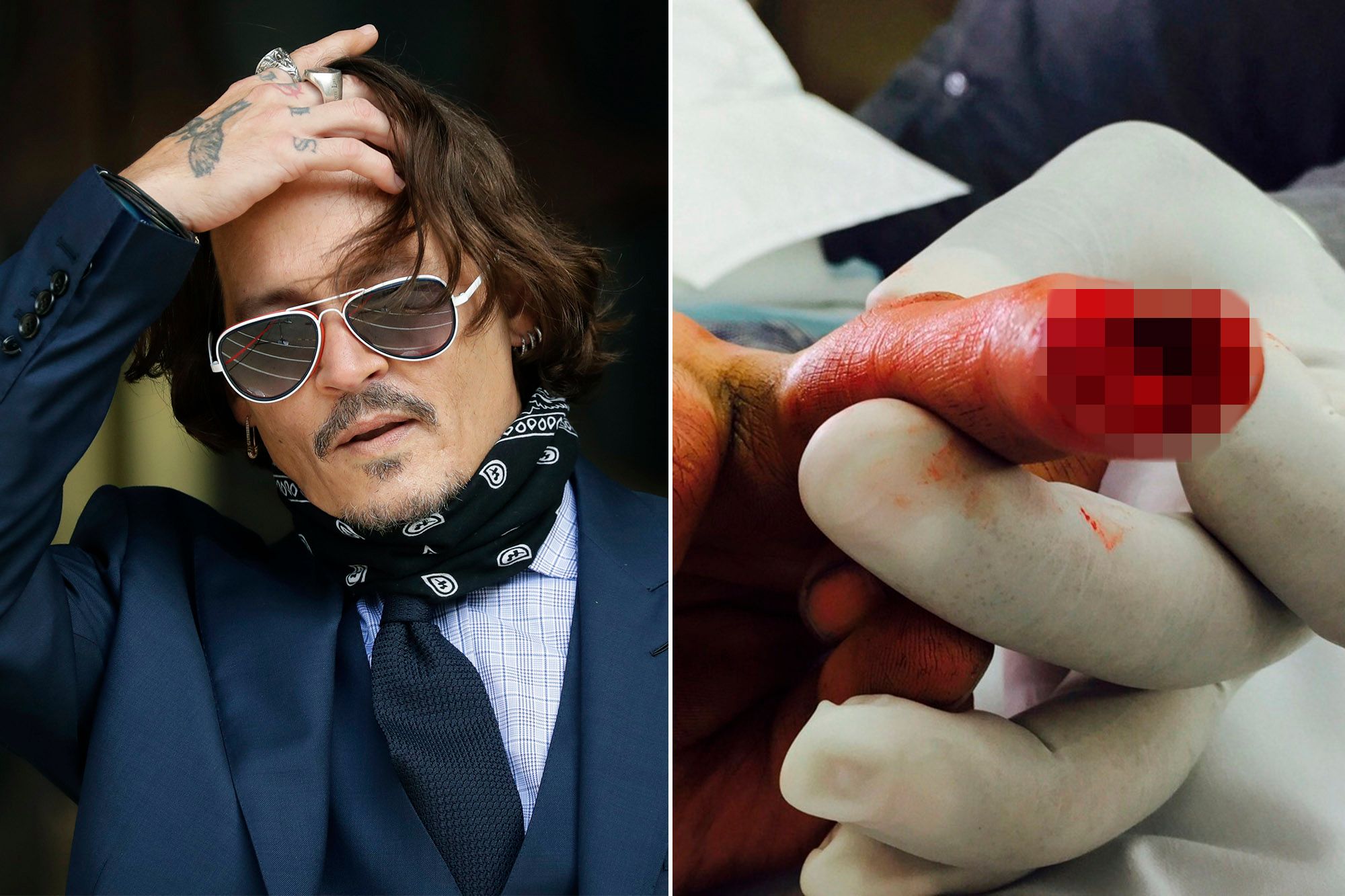 Johnny Depp Hand Injury Are Friends Concerned About Downward Spiral And Injury?