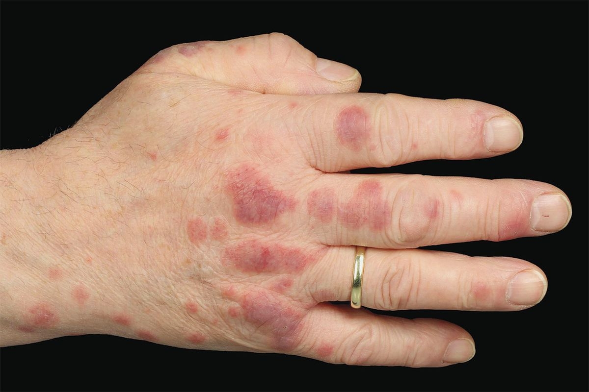 Man, 65, discovers his ‘painful rash’ is actually much more sinister