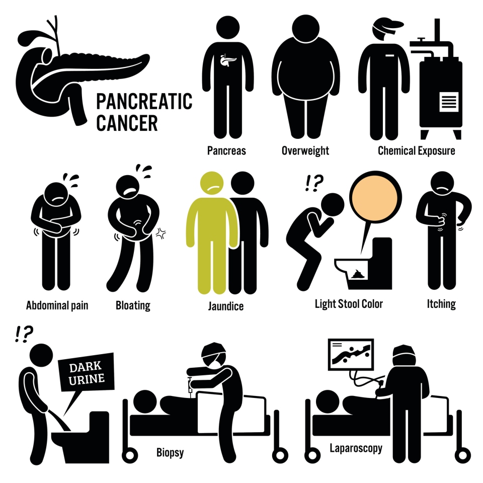 Symptoms of pancreatic cancer and how it might be diagnosed