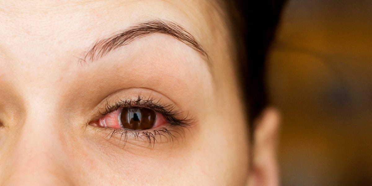 Three Ways to Treat Your Pink Eye at Home