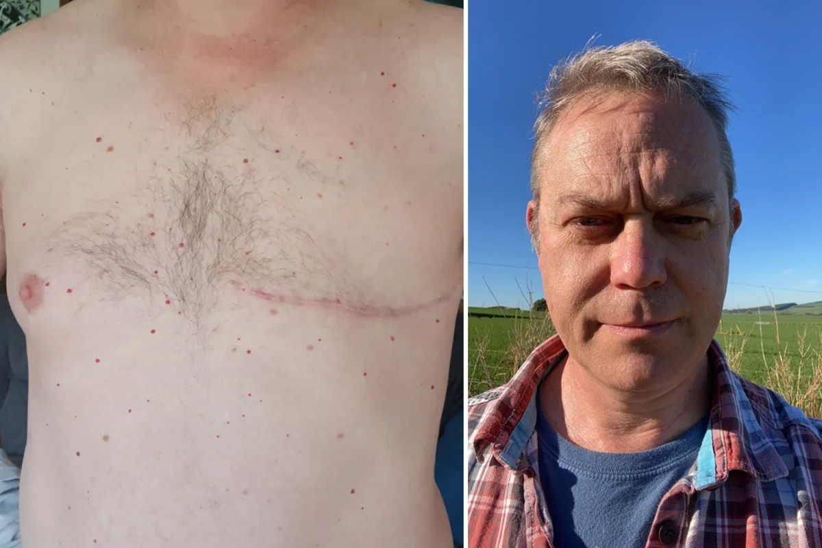 I was stunned when a ‘rugby injury’ turned out to be breast cancer 30 years later