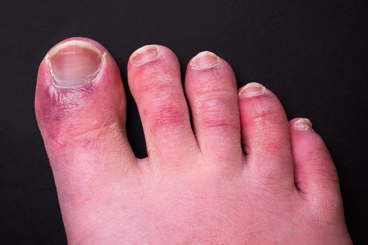 What is Covid Toes? What are the symptoms of Covid toes?