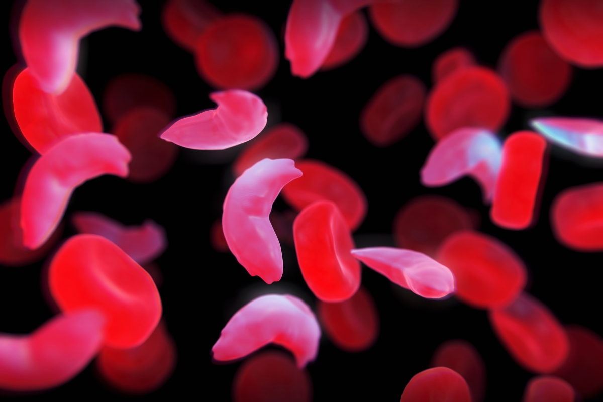 What is sickle-cell disease?