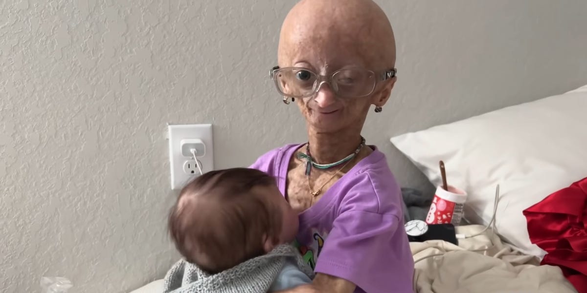 YouTuber With Progeria Died at 15