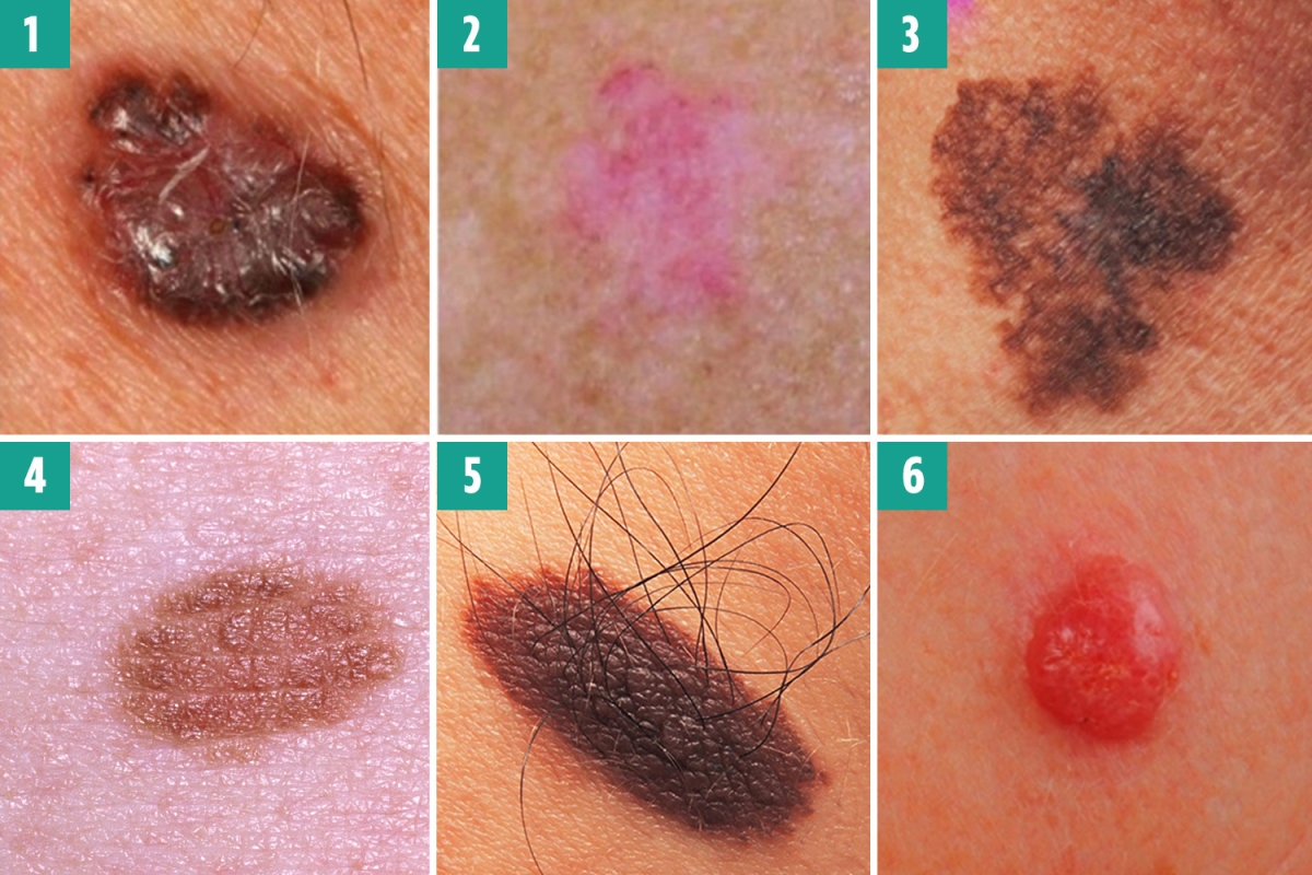 Can you spot the deadly moles from the harmless ones? The skin cancer signs you must never ignore – The US Sun