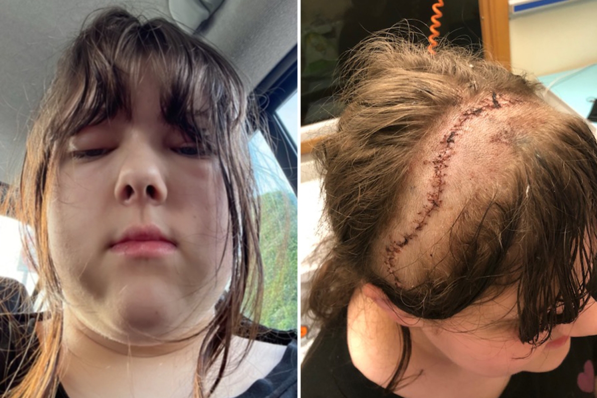 My daughter’s Covid turned into a nightmare as infection ate away at her skull