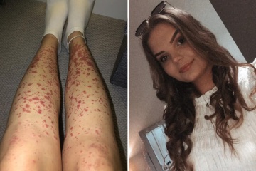 I thought horror rash on my legs was from partying too hard but it was my PILL