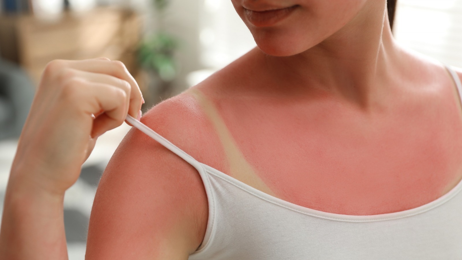 Bad Sunburns: The First Thing to Do