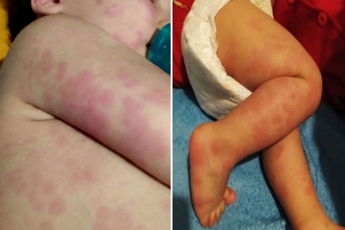 Parents should be aware of the possibility of Covid-related rash in their children.