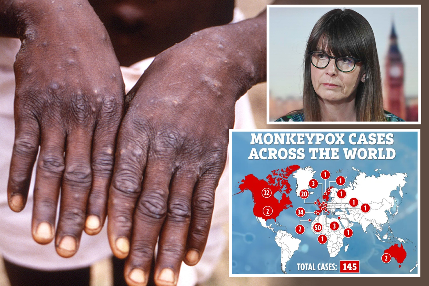 Belgium is first country to introduce monkeypox QUARANTINE as virus spreads across Europe & Brits given holiday warning