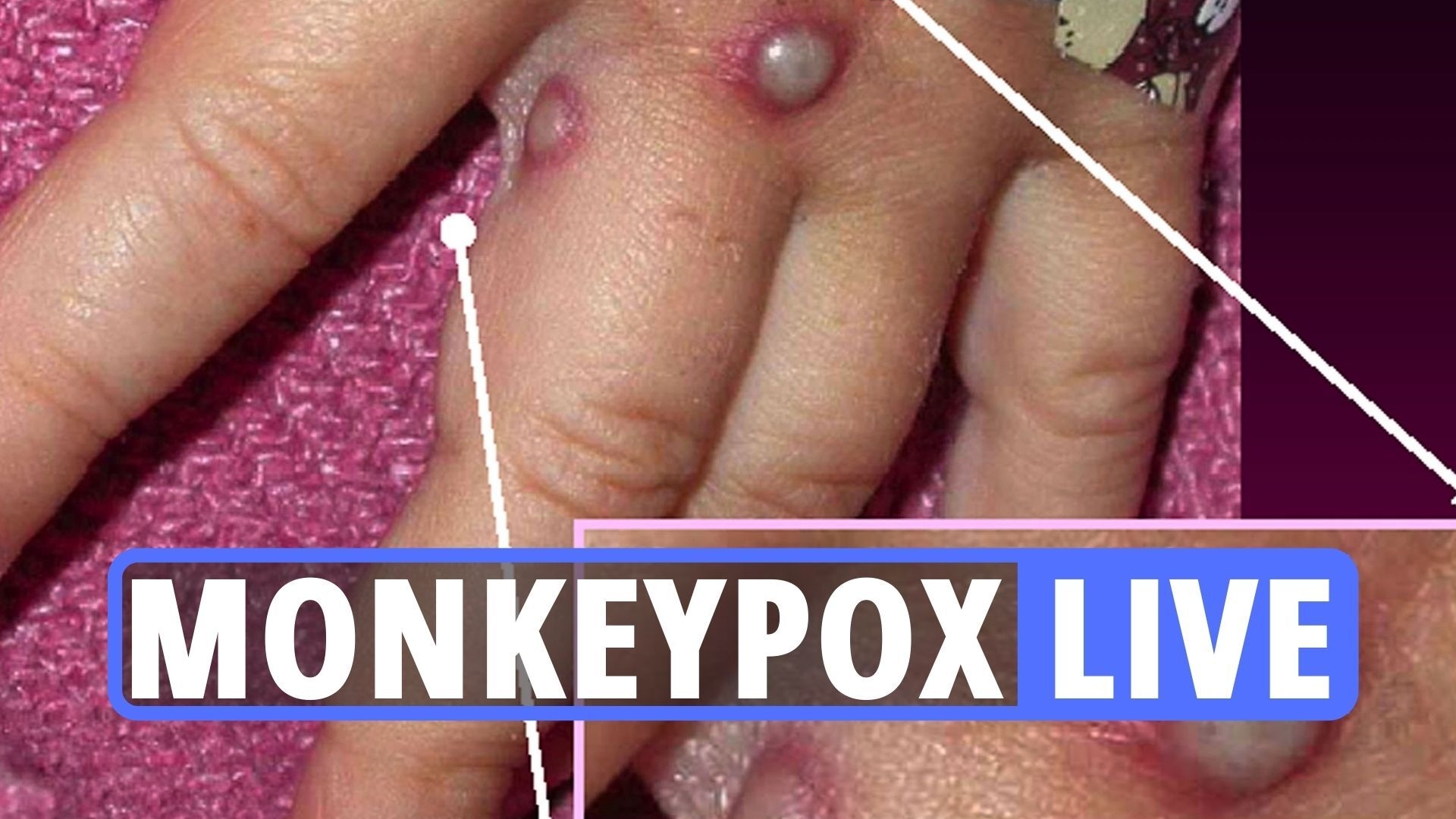 Monkeypox UK symptoms – Outbreak of contagious disease was ‘waiting to happen’, scientists say