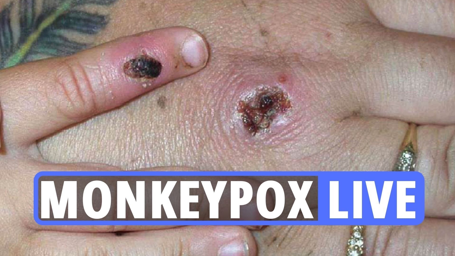 Monkeypox UK symptoms LIVE – WHO warns this could be the ‘peak of the iceberg’ as Virus infections pass 100