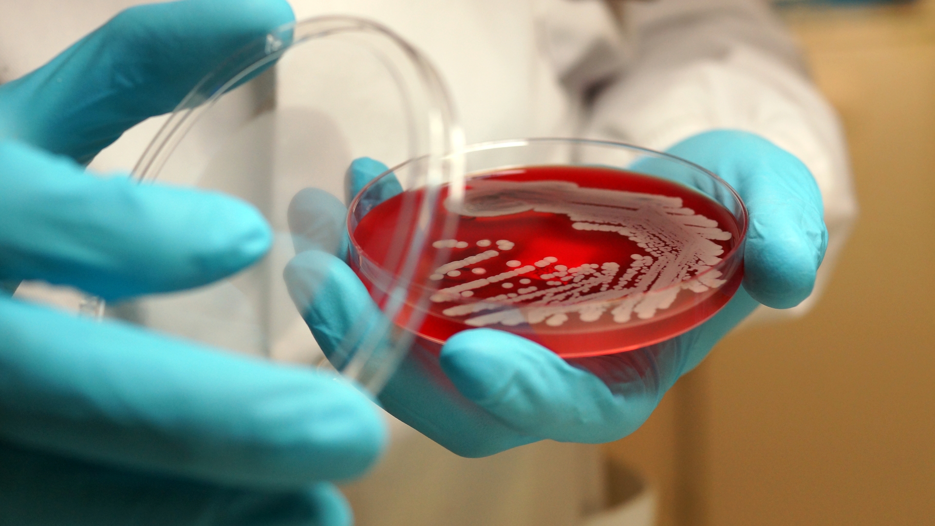Superbugs could trigger health crisis worse than Covid, experts warn