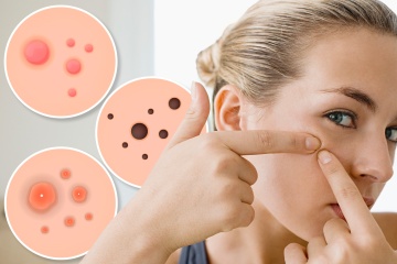 I’m a skin expert and here’s what your different spots mean