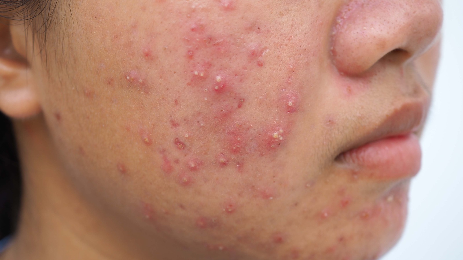 Cystic Acne: What Causes It? Symptoms And Treatments