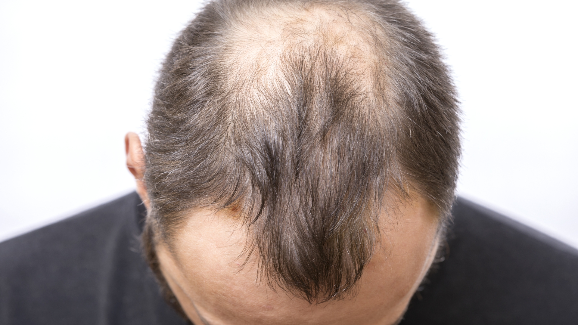 The simple patch that could ‘cure’ your baldness is a hope for thousands