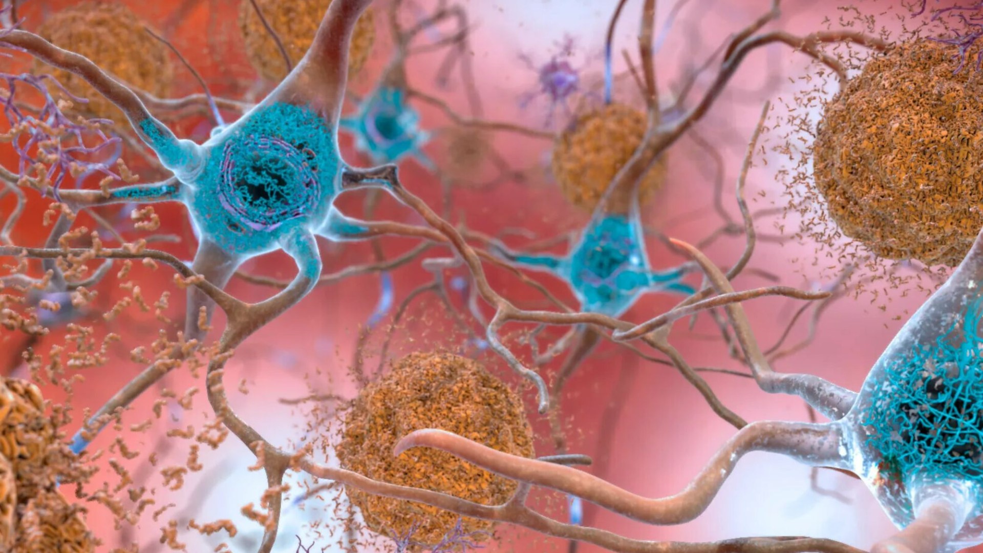 Scientists track brain cell death to find early warning signs of deadly Alzheirmer’s.