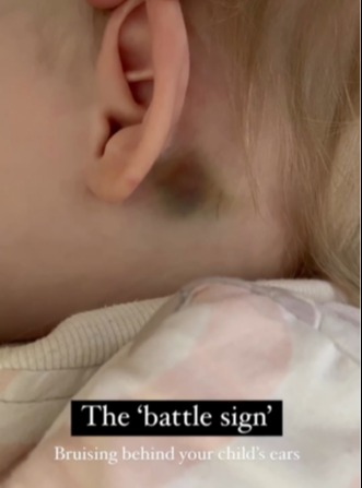 Bruising behind your child's ears after a head injury could indicate they have a fracture at the base of their skull