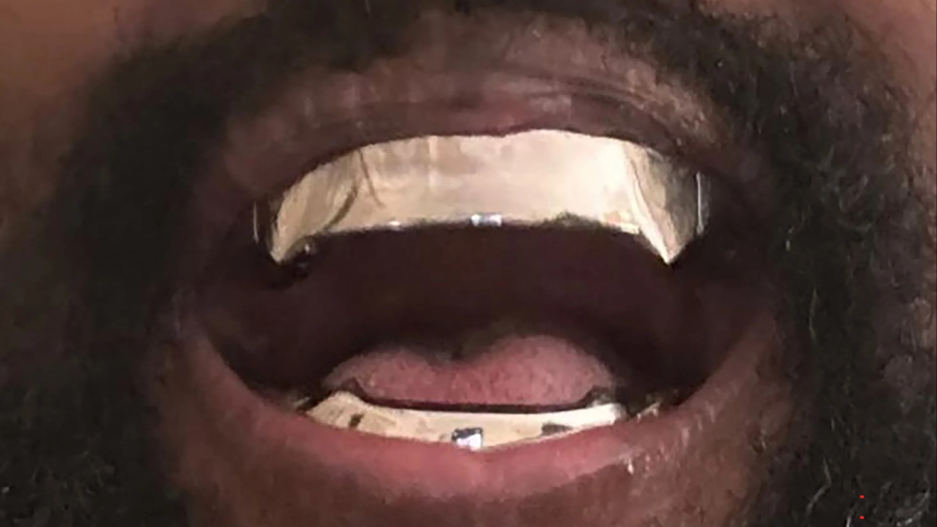 Shocking Revelation: Kanye West’s Titanium Dentures – The Truth Revealed!
