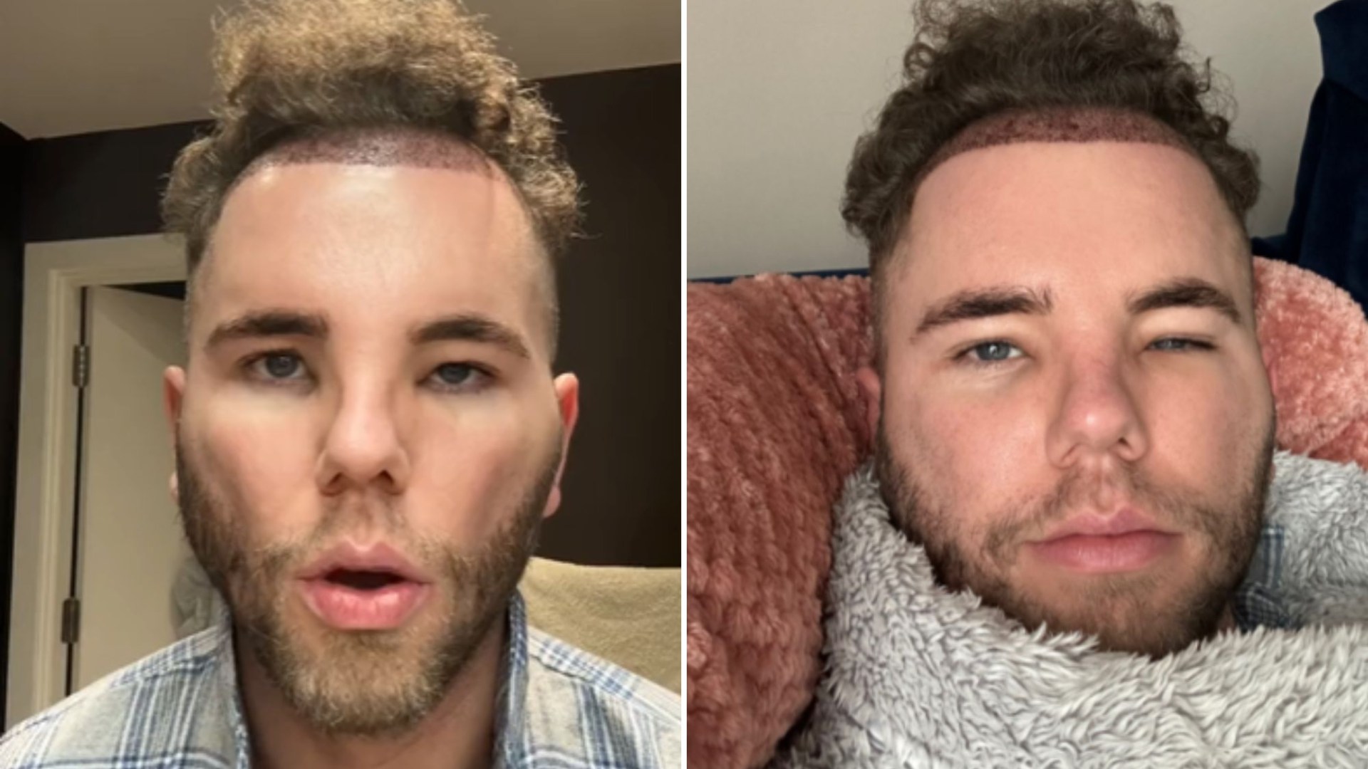 Radio 1 Star’s Avatar-Like Transformation: Swollen and Bruised Face After Hair Transplant