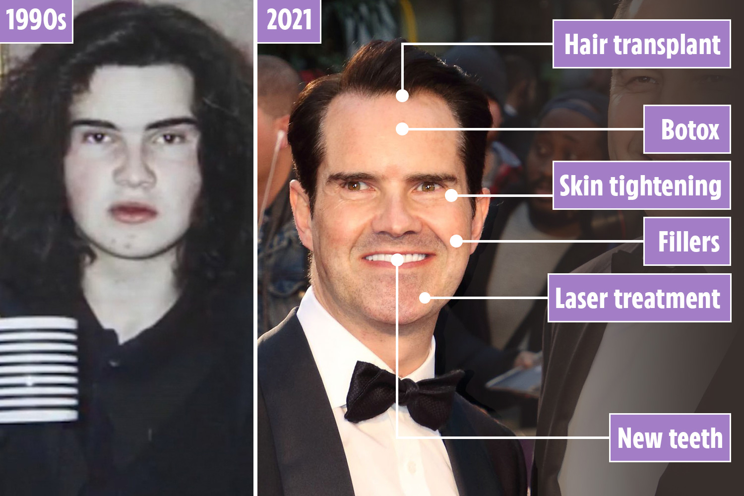 Jimmy Carr’s Shocking Midlife Transformation: Little Resemblance to Original Face Still There